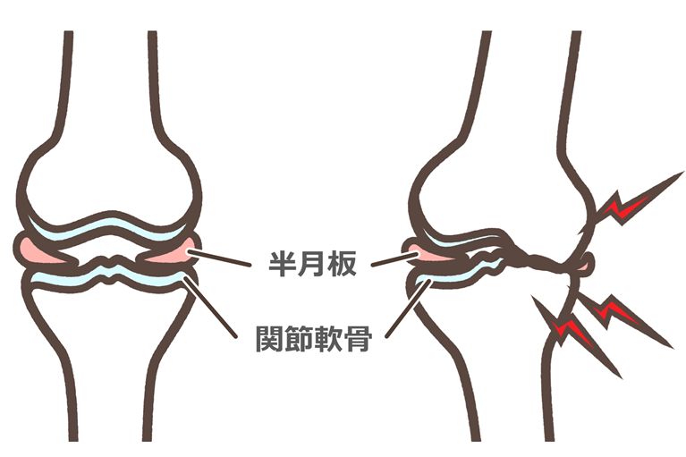 内側半月板損傷・変形性膝関節症の原因