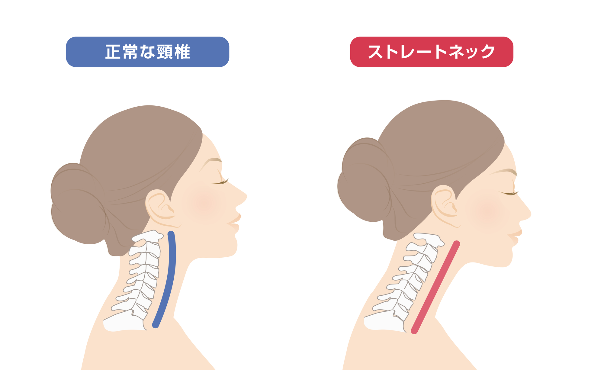 ストレートネックとは？-なかしま内科循環器・整形外科クリニック(西宮院)