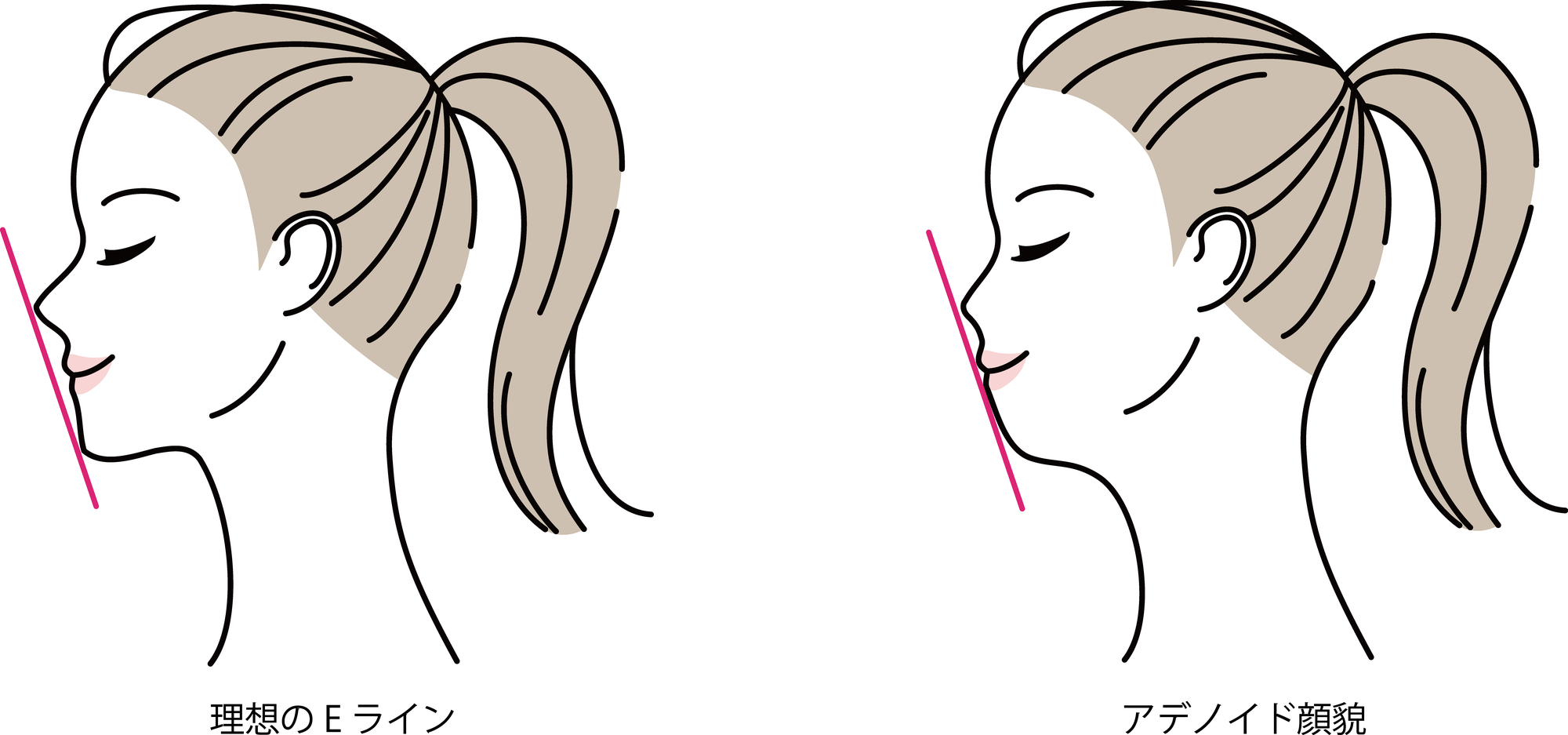 睡眠時無呼吸症候群になると顔つきは変わる？