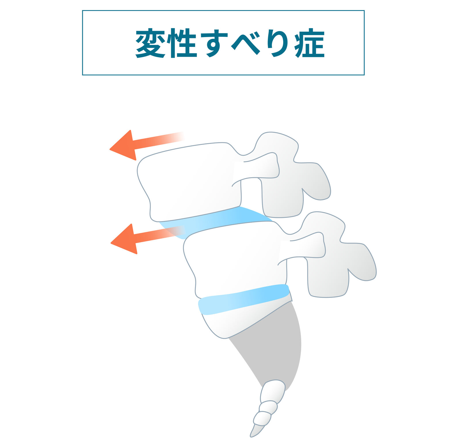 変性すべり症-なかしま内科循環器・整形外科クリニック(西宮院)