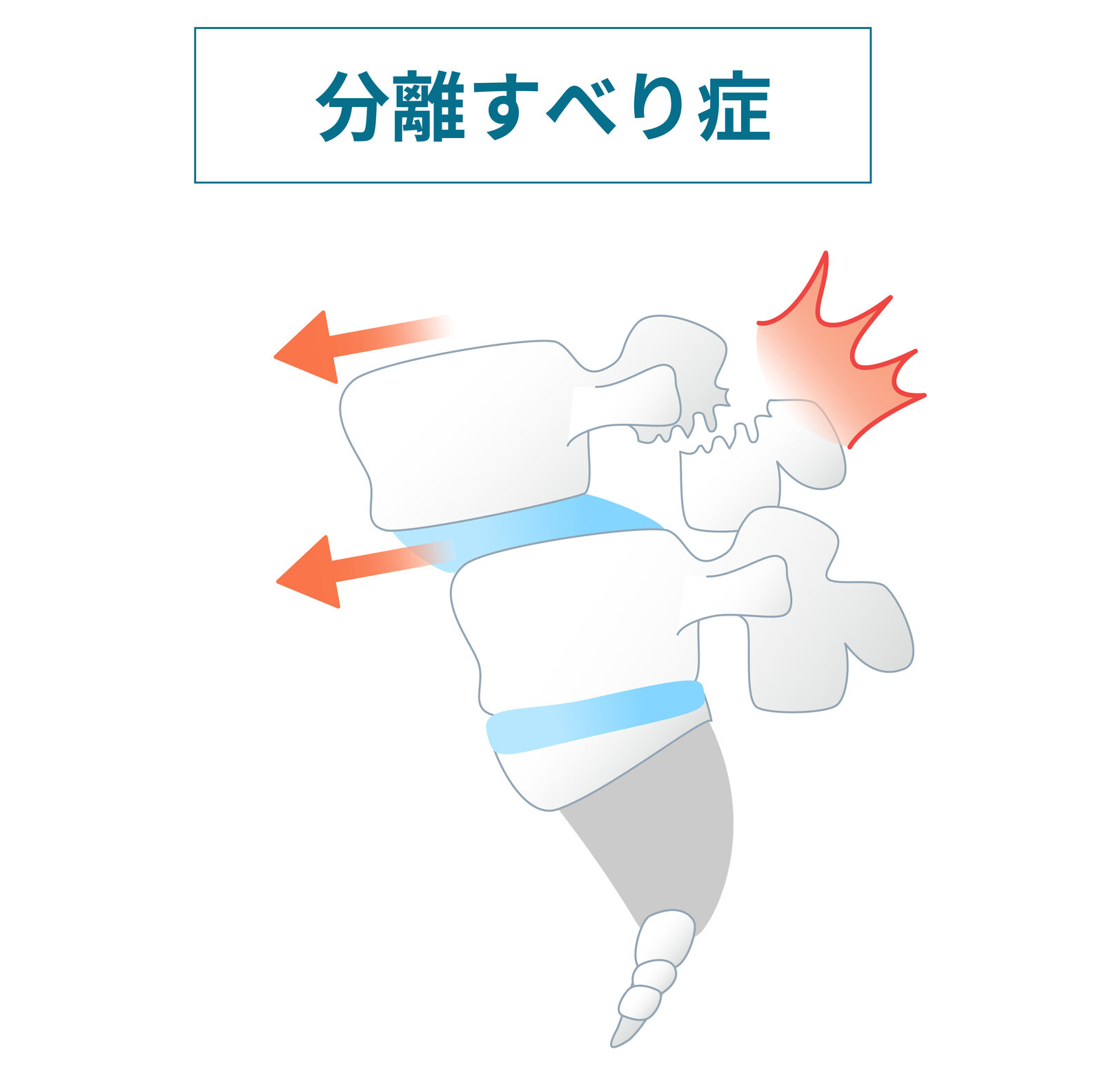 分離すべり症-なかしま内科循環器・整形外科クリニック(西宮院)