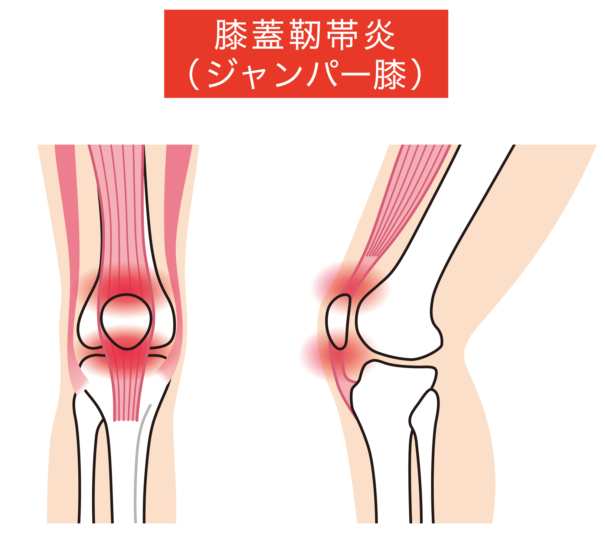 膝蓋腱炎（ジャンパー膝）のイラスト